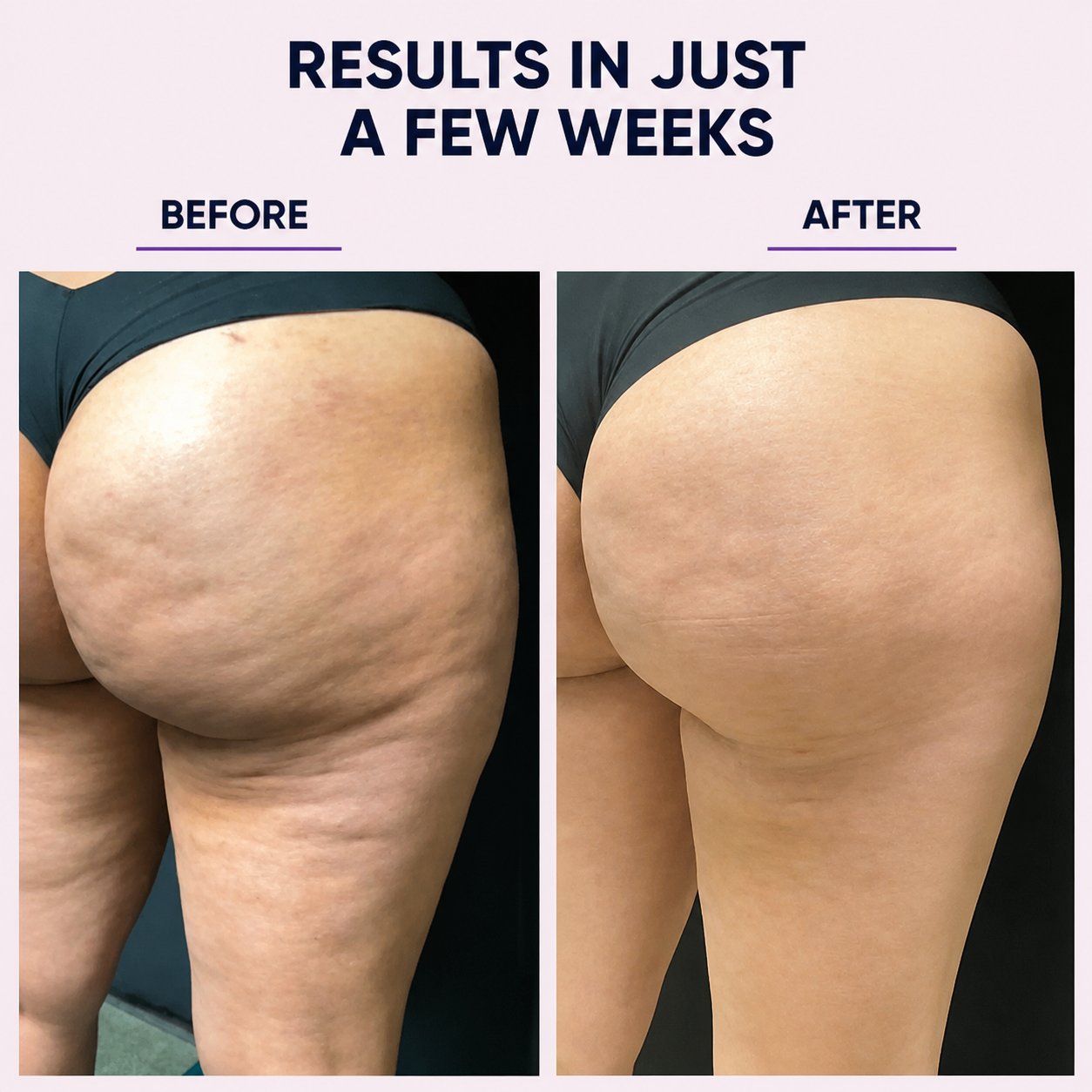 Anti-cellulite massager